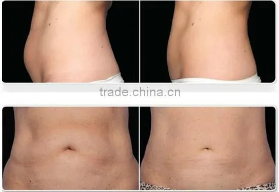 Portable Cryolipolysis for Home Use Has a Very Good Effective for Body Slimming photo-6