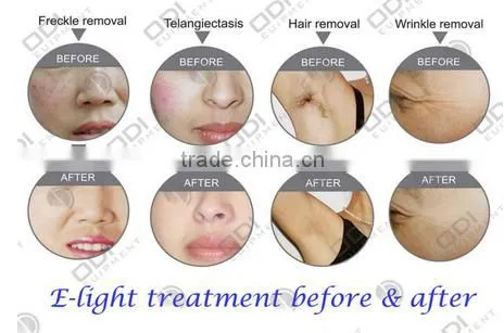 Beauty Machine Tattoo/hair Removal Beauty Salon/spa OD-IRL10 IPL RF E Light nd Yag Laser Price photo-6