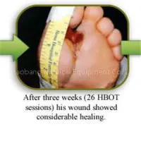 Lying Type Hyperbaric Chamber For Wound Healing
