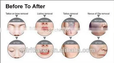 Express Acne Light, Elight Ipl Rf Nd Yag Laser, Light Ipl photo-2