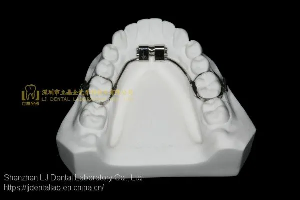 Space Expanders, Nance Appliance, Helix Appliance, Pendulum Appliance, ﻿﻿﻿﻿Porter Appliance, Fixed Lingual Expander, Sagittal Screw Appliance, Hyrax Rapid Palatal Expander, Orthodontic Retainers, Dental Orthodontic Appliance, Laboratoire Dentaire, Dentall photo-3