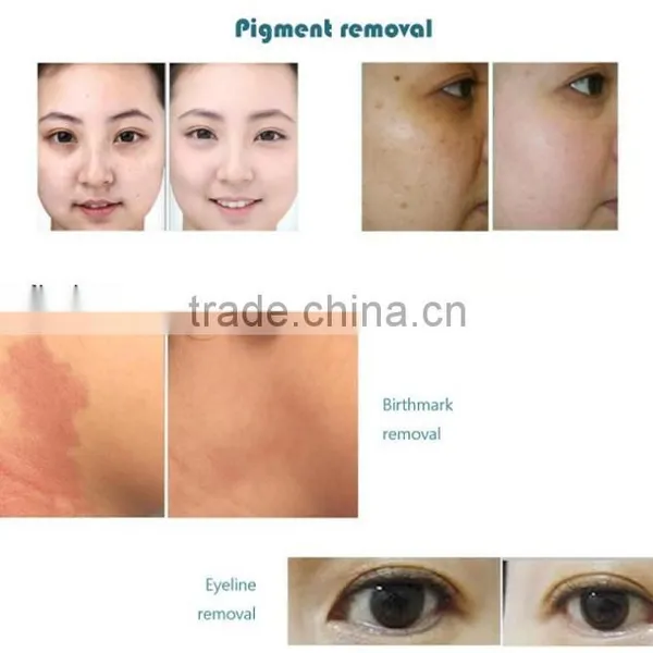 Easy Work Professional Laser Tatoo Removal/Tatoo Removal Machine/Nd YAG Laser CE Q Switched Hair Tatoo Removal photo-4