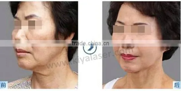Top Quality!! Ultra Age HIFU / HIFU Face Lift / HIFU Lifting for Skin Tightening and Wrinkle Removal photo-3