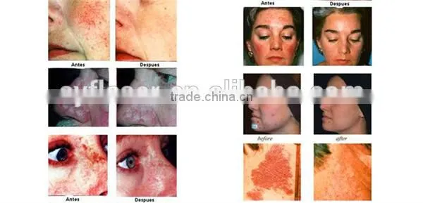 Wrinkle Removal Best Choice Face LED PDT Led Pdt Bio-light Anti-aging Therapy 7 Color Lights Pdt Machine In Usa Spot Removal photo-6
