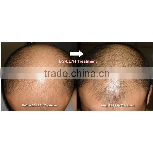 Professional Diode Laser Hair Regrowth Treatment photo-4
