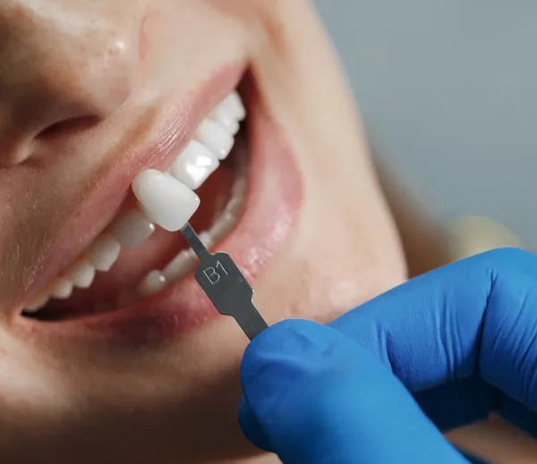 Quality Implant Crown and Bridge Manufacturers & Exporter - Buy Total Implant PFM Bridge China Dental Lab From China Manufacturer. photo-5