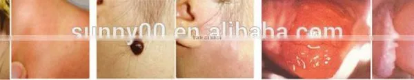 Benign Familial Pemphigus Treatment Laser Machine/co2 Laser Machine for Surgical photo-5