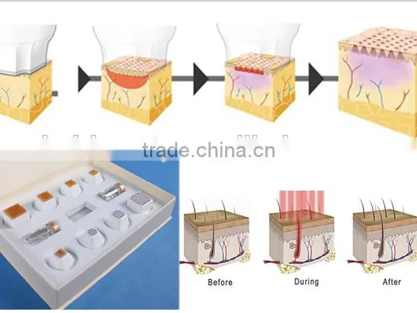 Hot Sale Portable Home-use RF 9D Thermacool Skin Resurfacing and RF Thermacool Effectively Machine photo-4