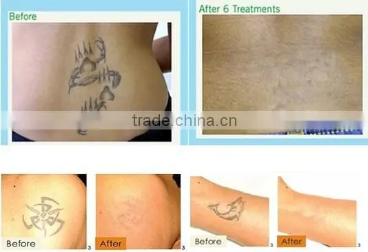 D003 Professional Laser Tattoo Removel Machine / Tattoo Equipment photo-6