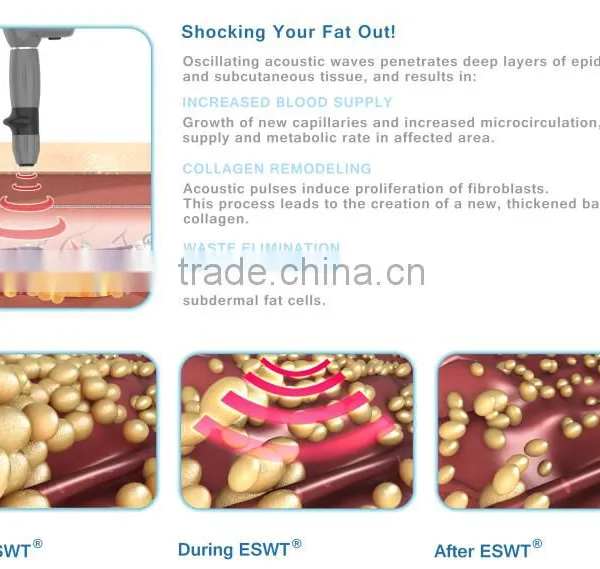 Latest Lipolysis RSWT Shockwave System Therapy For Body Fat Removal - Criowave 2016 photo-5
