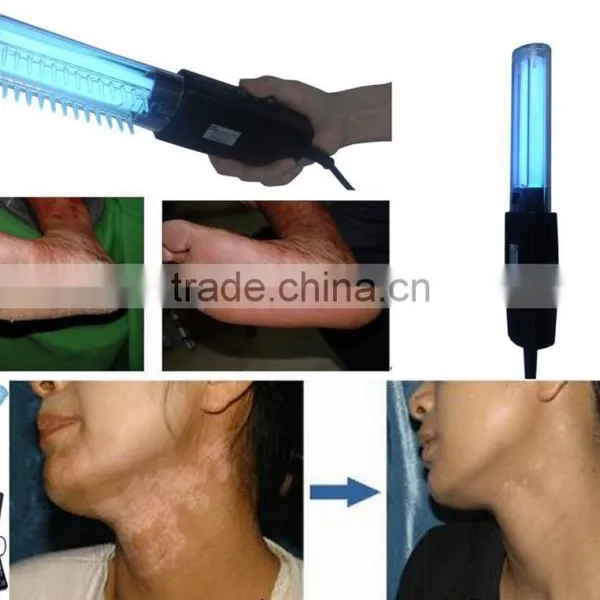 Shipping Free 311 nm nb Uvb Lamp for Vitiligo Treatment at Home!!! photo-4