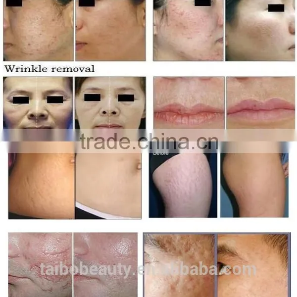 Skin Resurfacing 10600nm Laser Beauty Equipment Fractional Laser Vaginal Tightening CO2 Extraction Machine Stretch Mark Removal photo-6