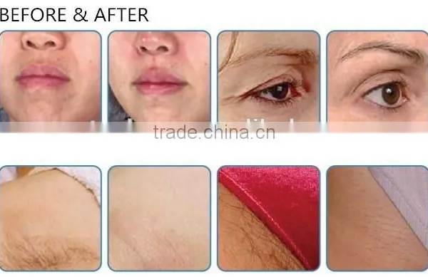 High Intensity RF Machine for Skin Tightening Face Lifting photo-5