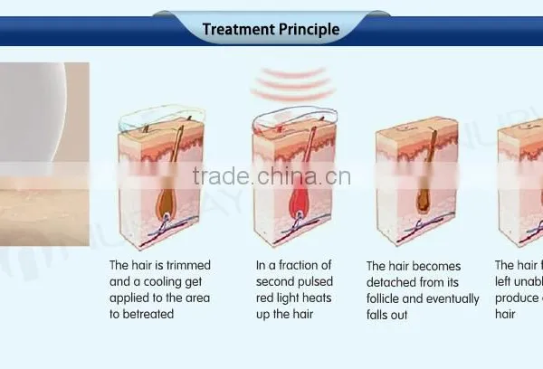 Most Effective Dark Skin Hair Removal! Diode Laser Permanent Hair Removal Device photo-6