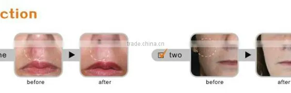 Promotion Best Professional Homeuse Acne Scar Laser Treatment Device photo-6
