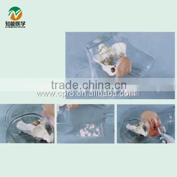 BIX-FT32 Transparent Curettage Model(medical Model)