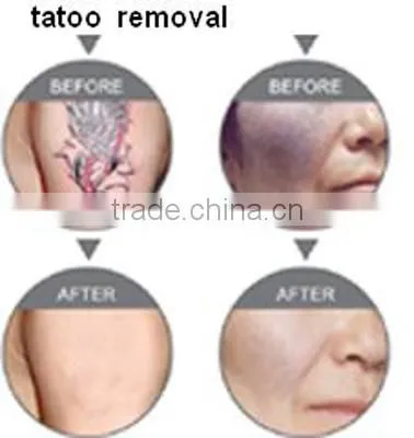 New Portable Q-switch nd -yag Tattoo/coffee Spots/senile Plaque/Birthmark Beauty Spot Removal Permanently Laser no Pain Beauty m photo-6