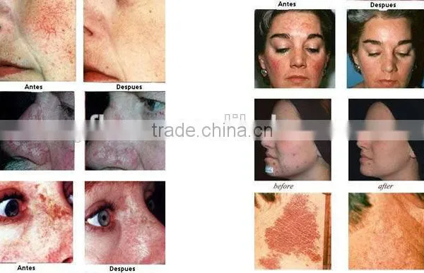 Led Light For Skin Care 2016 Popular In Many Countries Bio Light Therapy LED PDT Skin Rejuvenation Therapy Skin Rejuvenation photo-6