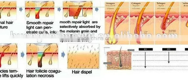 Elight /YAG Laser Elight Hair Removal Machine photo-4