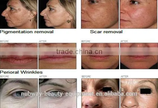 Vaginal Rejuvenation 30W High Power Fractional Co2 Skin Tightening Laser Beauty Machine Skin Treatment Device photo-6