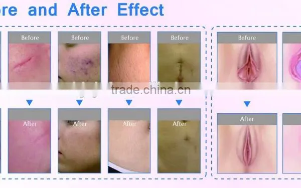 Wrinkle Removal Anybeauty F7+ Beauty Device 15W(20W) Fractional CO2 Laser Equipment Vaginal Tightening Machine photo-5
