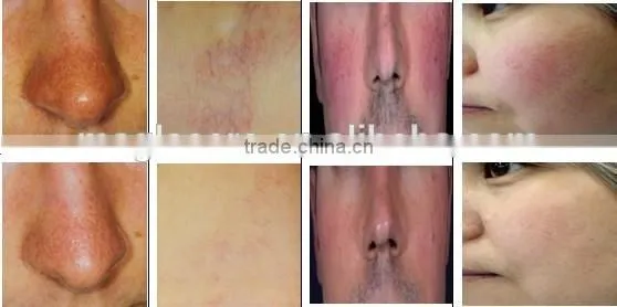High Frequency  HIFU-C New Tech! HIFU Forehead Wrinkle Removal For Face Body Slimming Machine/liposunic Ultrasound Machine/cellulite photo-3