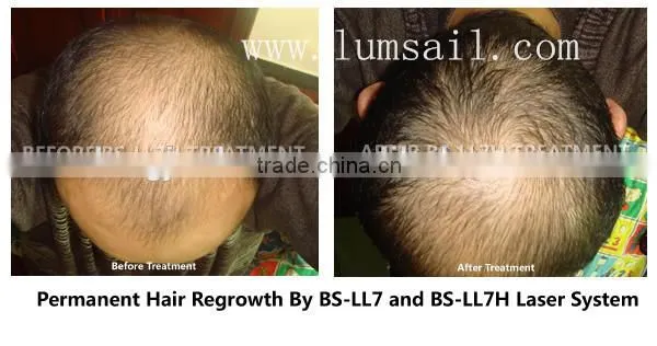 Fine Design Bio Laser Hair Growth Machine/Hair Regrowrth Device/ Hair Loss Treatment Instrument photo-2