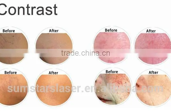 Spider Veins Removal / Laser Vascular Lesions / 980nm Diode Laser photo-6