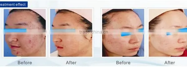 Acne Removal,skin Rejuvenation, Scar Removal Light Therapy System photo-2
