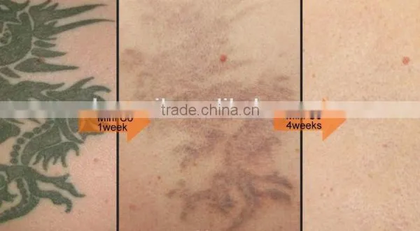 Most Effective Tattoo Removal YAG Laser Equipment photo-2