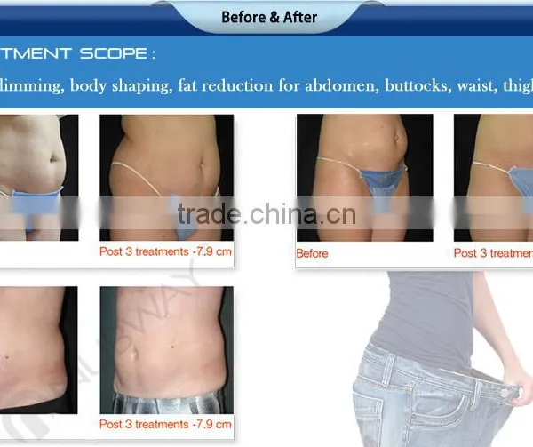 CE / FDA Approved High Effective HIFU Shape Body Slimming Machine Far Infrared Slimming Pressotherapy Machine photo-6