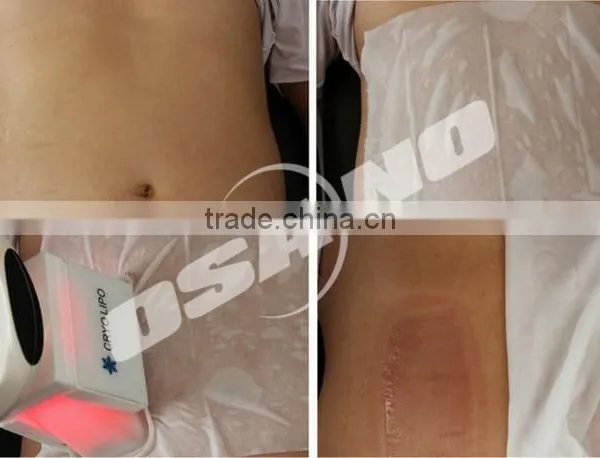 New Portable Slimming Machine Cryotherapy for Weight Loss photo-5