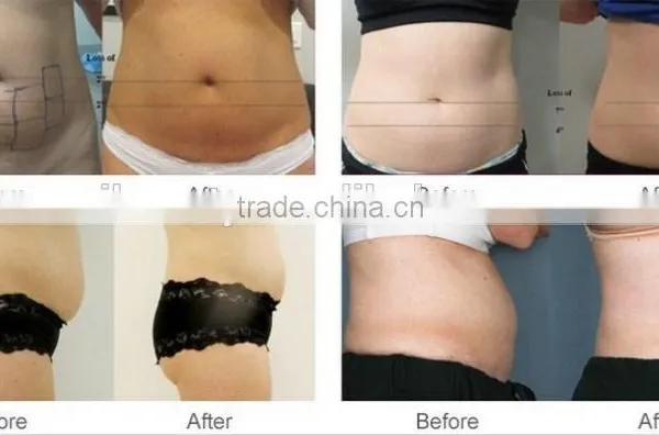 Improve Blood Circulation Eye Lines Removal Hifu Shape Cool Sculpting Slimming Machine High Focused Ultrasonic Liposonic Ultrasound Slimming Machine photo-6