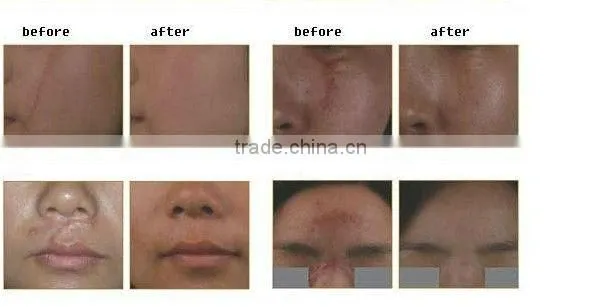 rf Fractional Co2 Metal Tube Home Laser Scar Removal photo-2