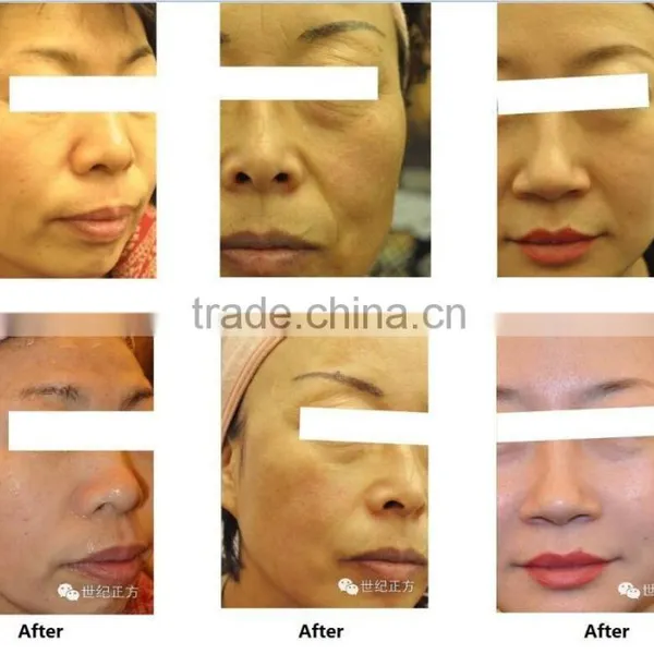 Skin Tightening Anybeauty Portable Hifu Slimming Machine Ultra Age Hifu Cartridge Face Lifting photo-2