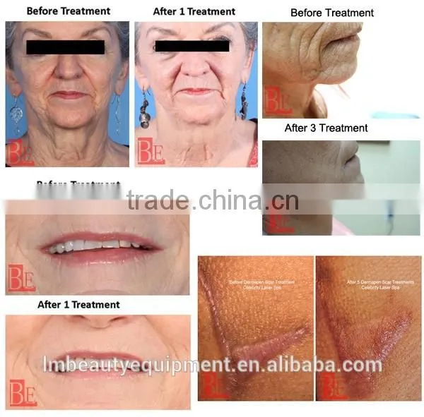 Fractional Radiofrequency Micro Needles for Permanent Makeup photo-6