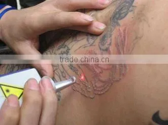 Q Switched 1064nm 532nm ND YAG Laser Tattoo Removal Pigment Removal photo-5