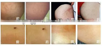 Wart Removal Salon Vertical RF Co2 Wrinkle Removal Fractional Laser Skin Treatment Machine Sun Damage Recovery Sun Damage Recovery photo-6
