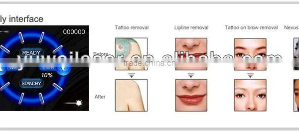 Good Quality Portable q Switched Tattoo Removal Equipment photo-5