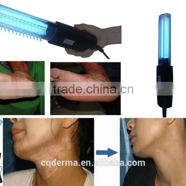 Effective UV Vitiligo Treatment -uv Phototherapy Lamp for Vitiligo Curing photo-3