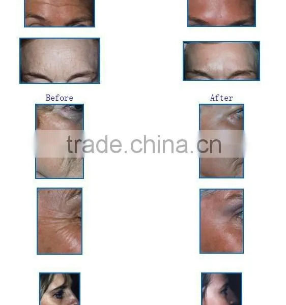 YUWEI RF Radio Frequency Eye Body Face Lift Eye Care Massage photo-6