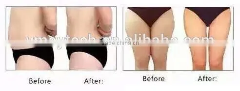 Weight Loss Hifu Ultrasound Expression Lines Removal Korea Slimming Machine FU-18S 0.1-2J photo-3