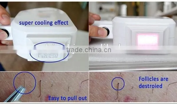 Permanent Fast Painless 808nm Diode Laser for Hair Removal With ce photo-4