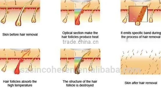 NYC (opt Technology ) Laser Hair Removal and Skin Rejuvenation Machine photo-6