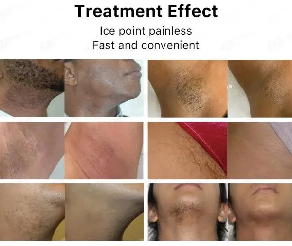 Laser Hair Removal Machine With 1-Year Warranty and Training photo-5
