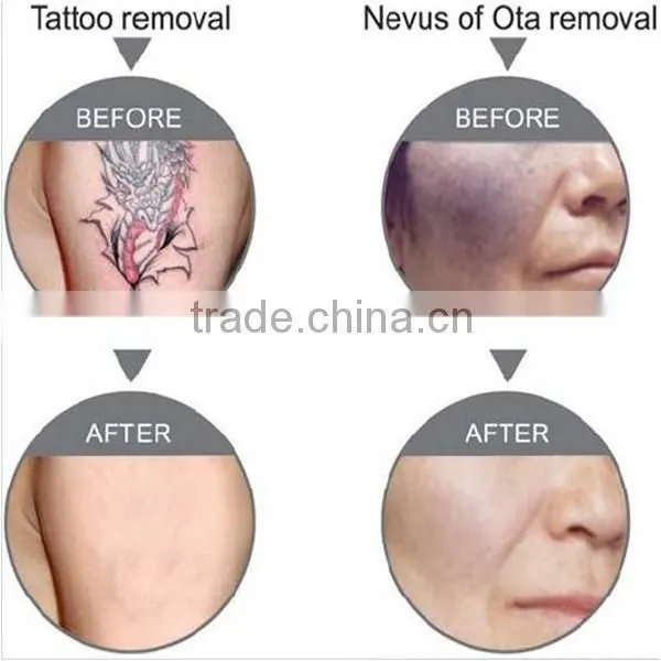 Freckles Removal Most Popular ND YAG Facial Veins Treatment Laser Price Tattoo Removal Laser Machine photo-5