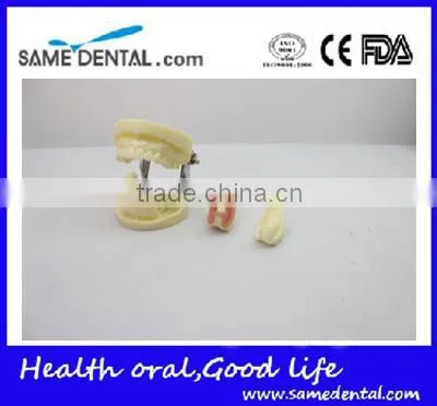 Dental Implant Practice Model DEA-31 Teeth Implant Models photo-5