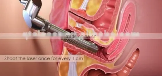 Newest Professional Fractional CO2 10600nm Laser Female Orgasm Device Vaginal Lasers Korea photo-3