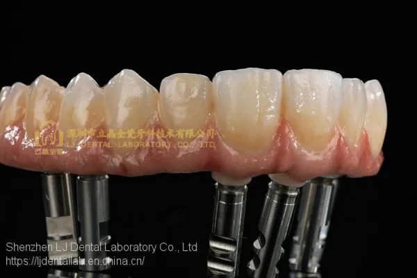 Full-arch Implant Bridge Prosthesis, Implant Denture Framework, Implant Prosthesis, Laboratoire Dentaire, Dentallabor, Laboratorio Dental, Dental Laboratory, Shenzhen LJ Dental Lab China photo-5
