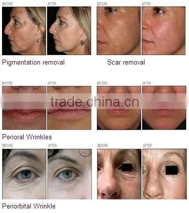 Medical RF Tube Fractional CO2 Laser Vaginal Tightening Gynecology Laser photo-3